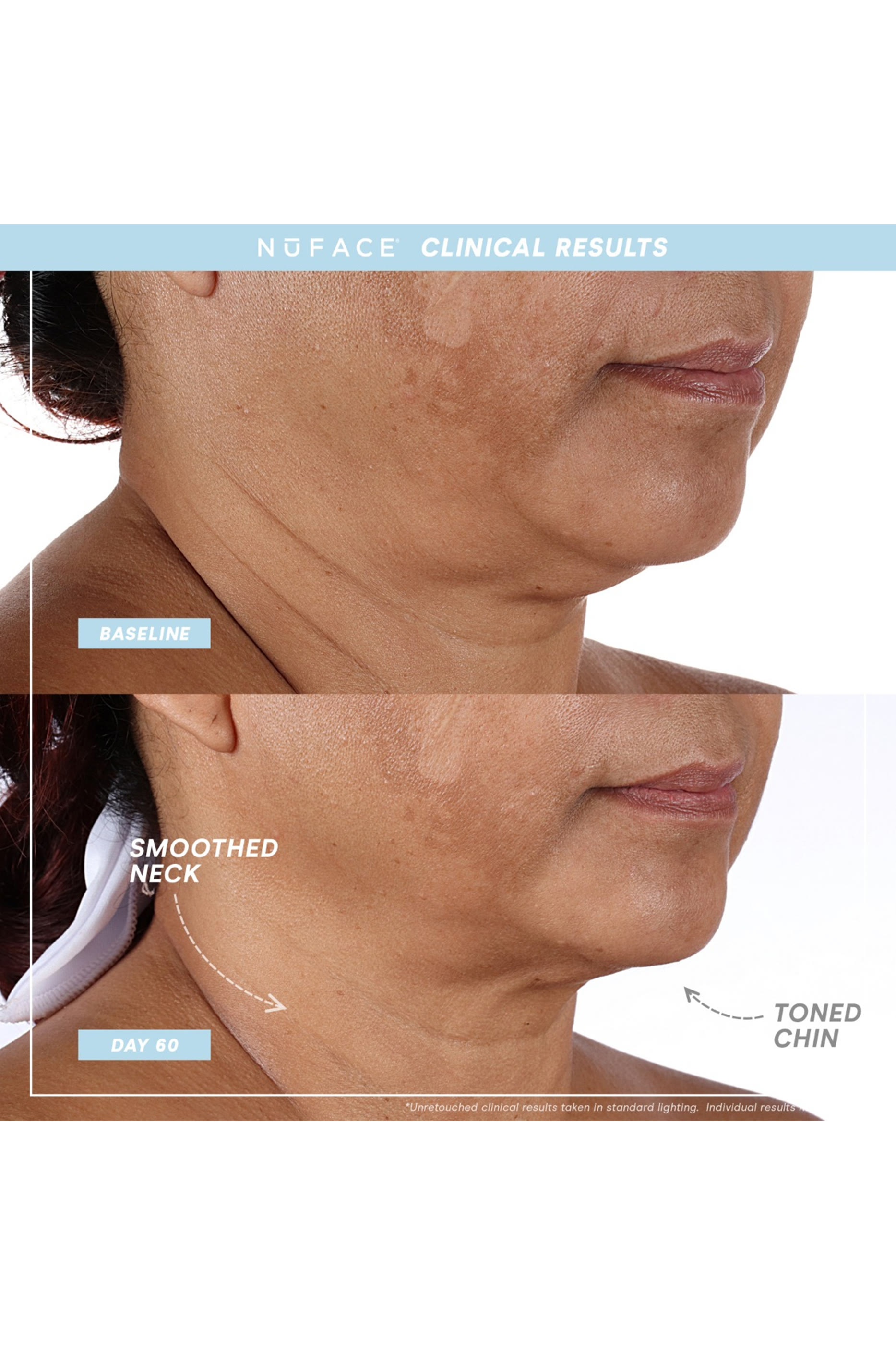 Trinity+ ELE and TWR Attachments Set