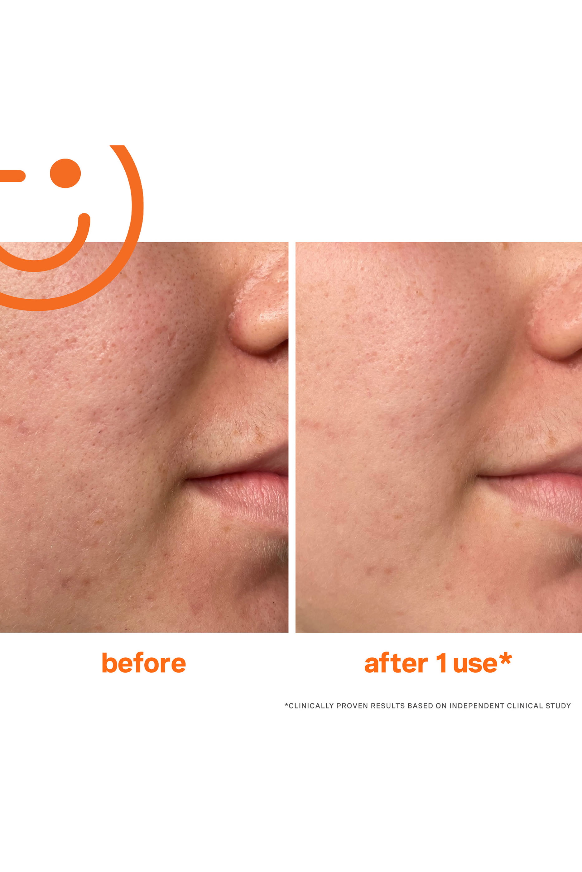 ExfoliKate&reg; Intensive Exfoliating Treatment